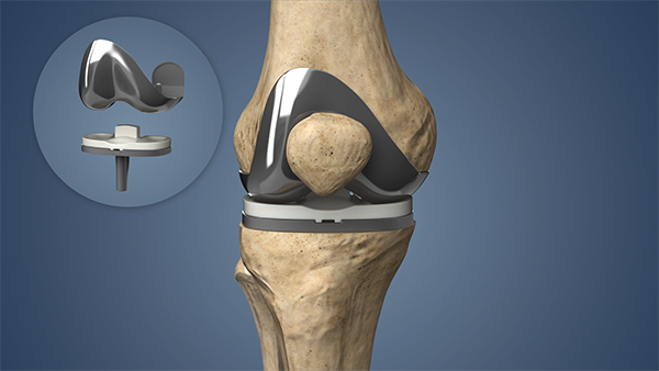 Knee Surgery